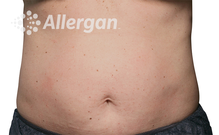 Female abdomen image 3_Desk