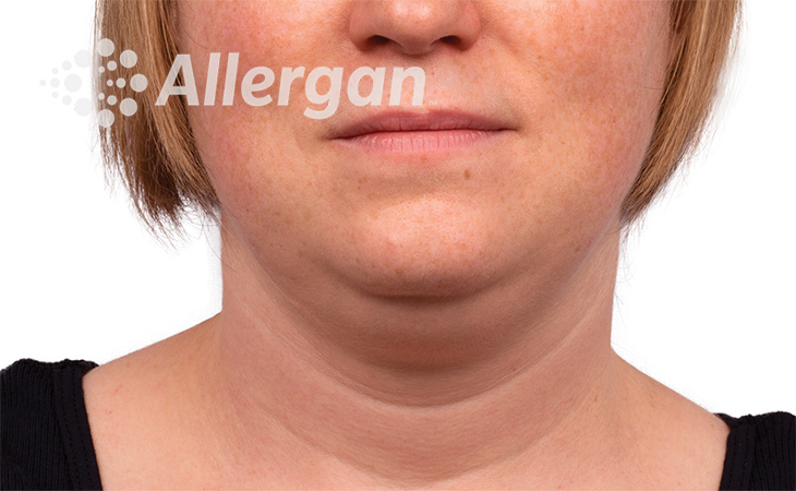 Female-double-chin-image_1